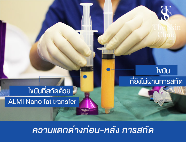 Hair Transplant Bangkok