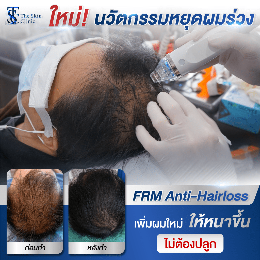Hair Transplant Bangkok