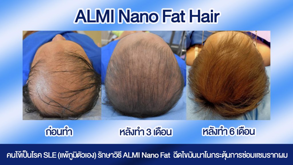 Hair Transplant Bangkok