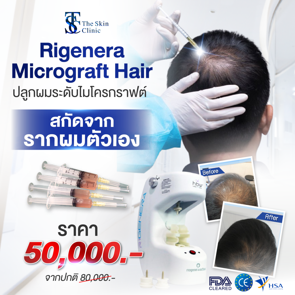 Hair Transplant Bangkok
