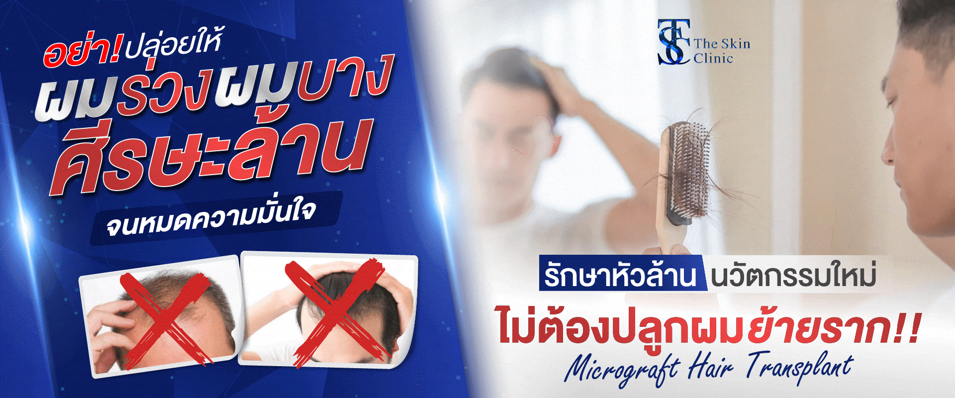 Hair Transplant Bangkok