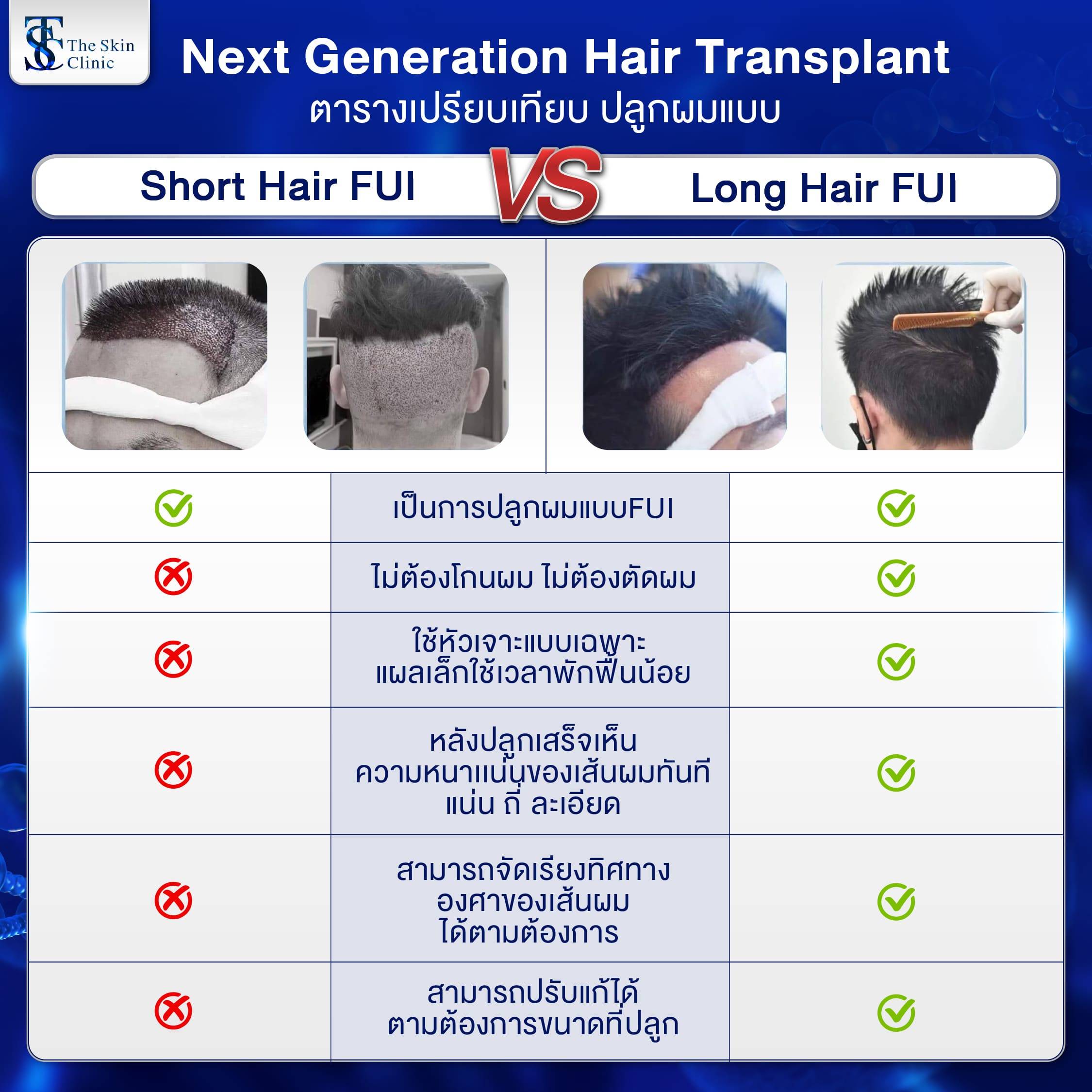 ปลูกผม