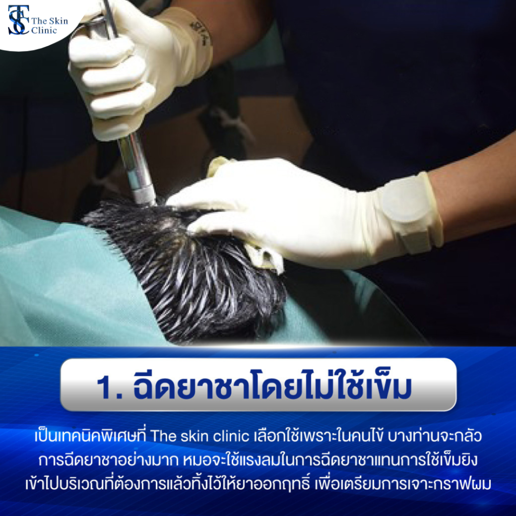 ฉีดยาชาโดยไม่ใช้เข็ม ปลูกเผมเทคนิคเจ็บน้อย เฉพาะที่เดอะสกินคลินิก
